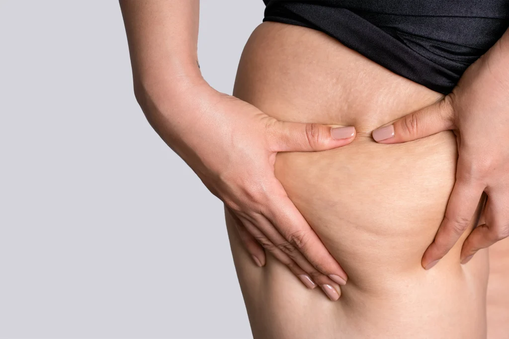 Lipedema