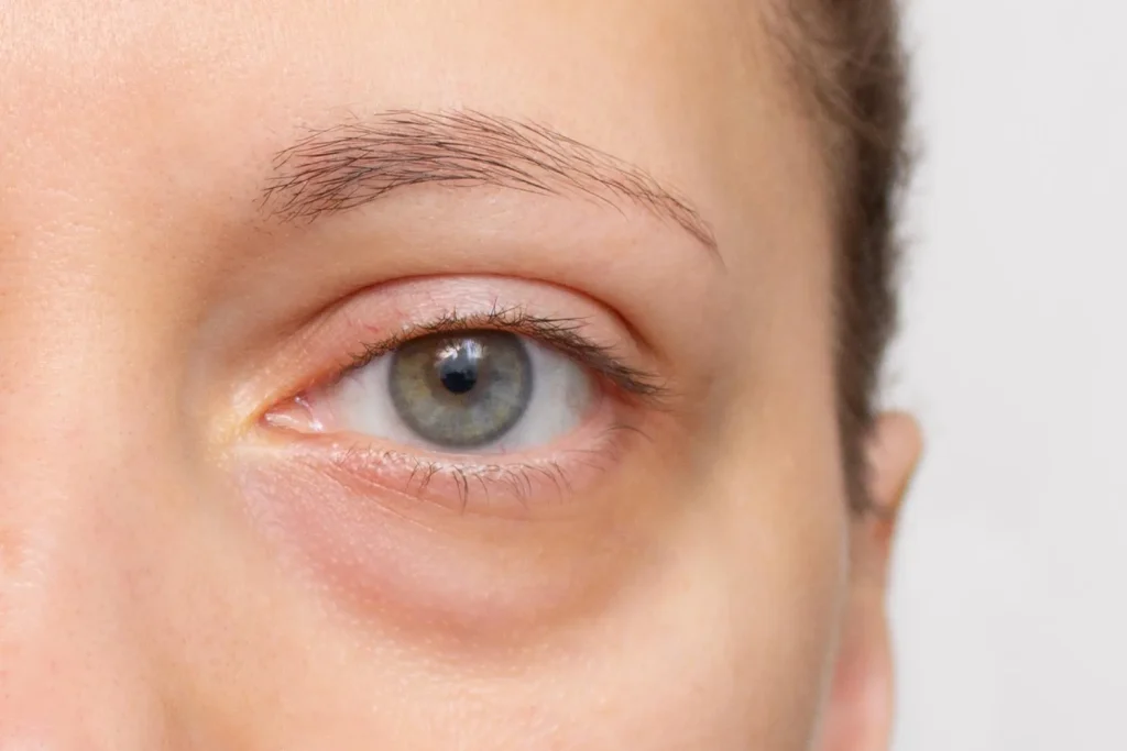 Nahaufnahme Auge mit sichtbaren Tränensäcken am Unterlid
